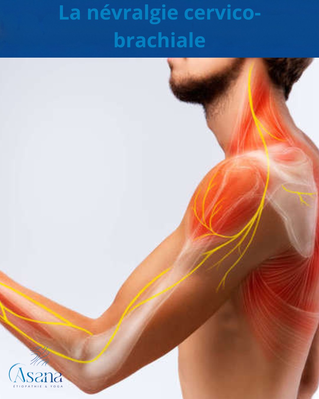 Comprendre la névralgie cervico-brachiale (1/3)